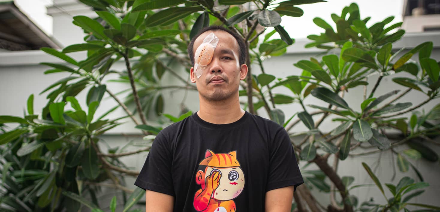 Payu Boonsophon sigue luchando tras perder la vista por una bala de goma disparada por un policía durante una protesta