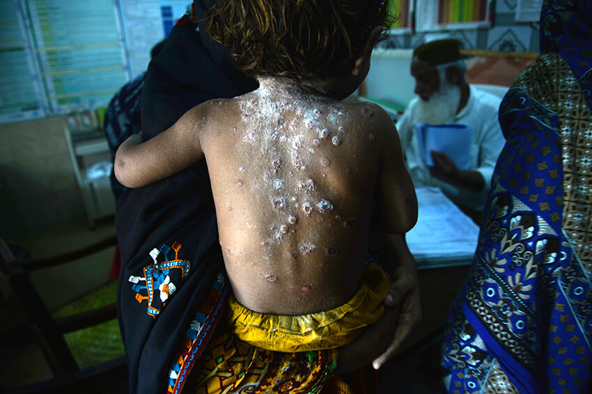 Un niño recibe tratamiento en una clínica por una afección cutánea causada por la exposición al sol